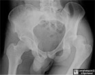 Posterior Hip Dislocation